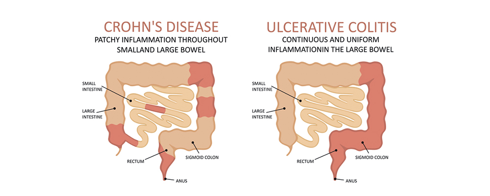 Crohn S Disease Vs Ulcerative Colitis Chart