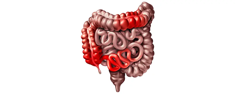 Inflammatory Bowel Disease