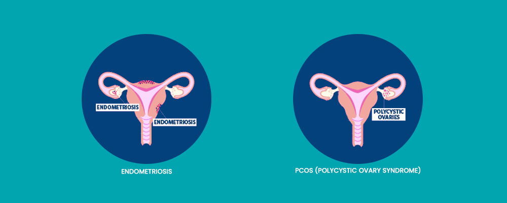 PCOS vs Endometriosis Symptoms