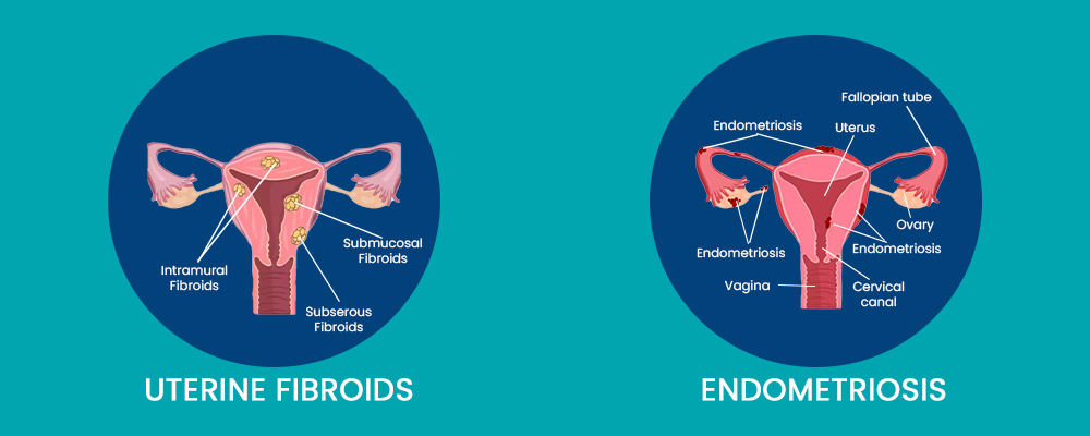 endometriosis vs fibroids differences