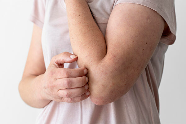 Multiple Sclerosis and Skin Rash